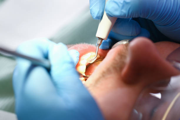 Best Broken or Chipped Tooth Repair in , CO